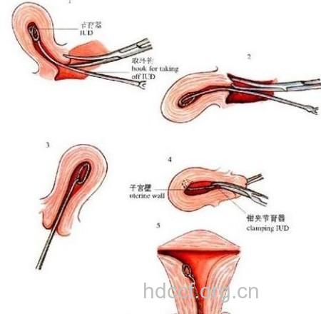 取环怎么取 女性取环手术全过程