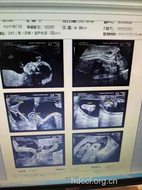四维彩超 孕囊数据看男女