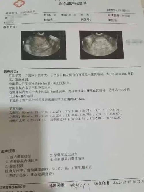 B超检查 葡萄胎b超能看出来吗