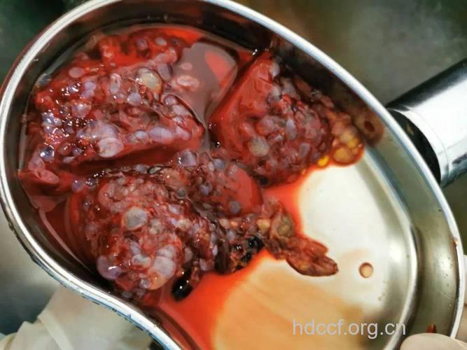 闭经阴道流血 葡萄胎的7大早期症状