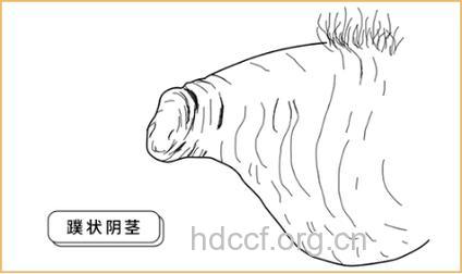 男人这里短小很羞愧 小心掉入阴茎短小误区