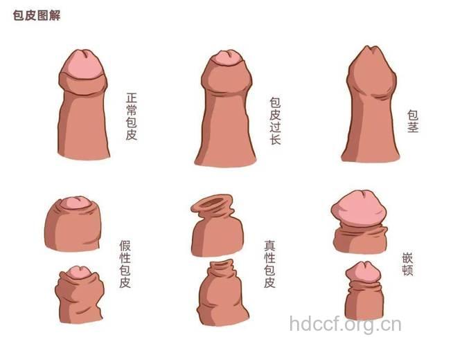 阴茎短小 令男人无法忍受的包茎危害