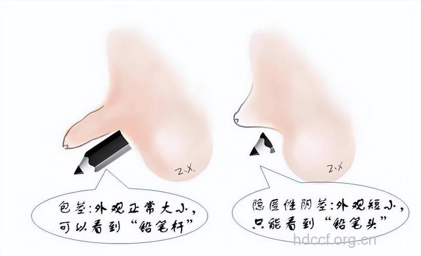 男性生殖器官短小要整形 术后护理很重要
