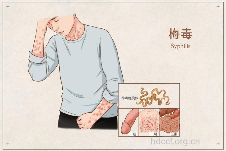 男性生殖器图片之梅毒