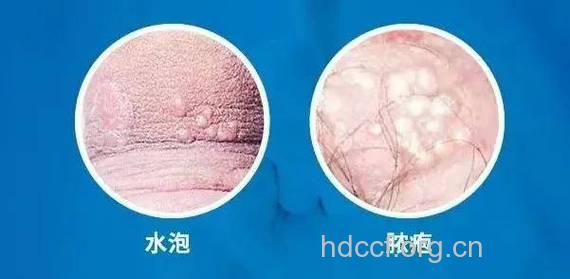 男性生殖器图片 生殖器疱疹怎么办