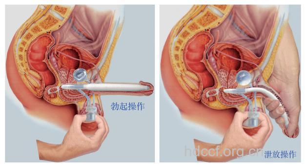 增强男性生殖器能力的方法