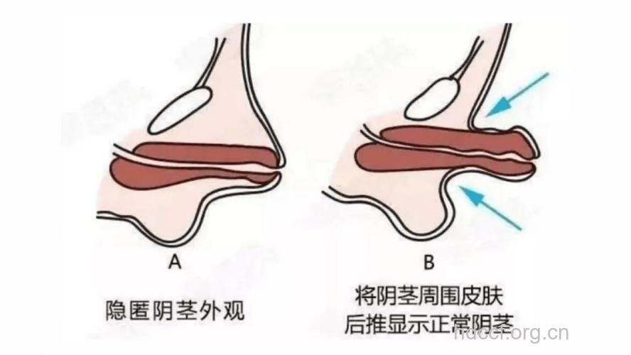 男人阴茎短小的症状有哪些