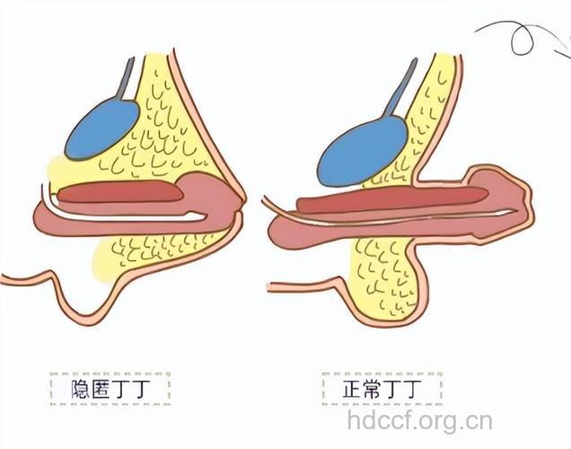 阴茎短小会影响性交吗？