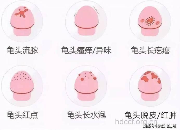 包皮囊肿如何护理 避免不洁性交