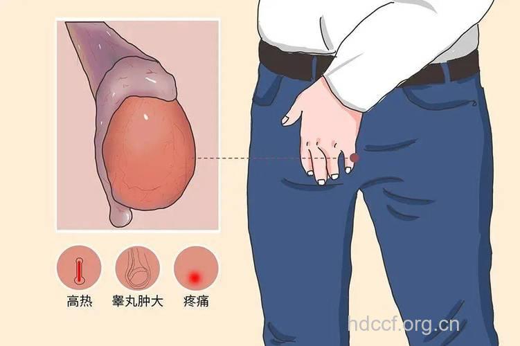 引发男性不育的生殖系统疾病