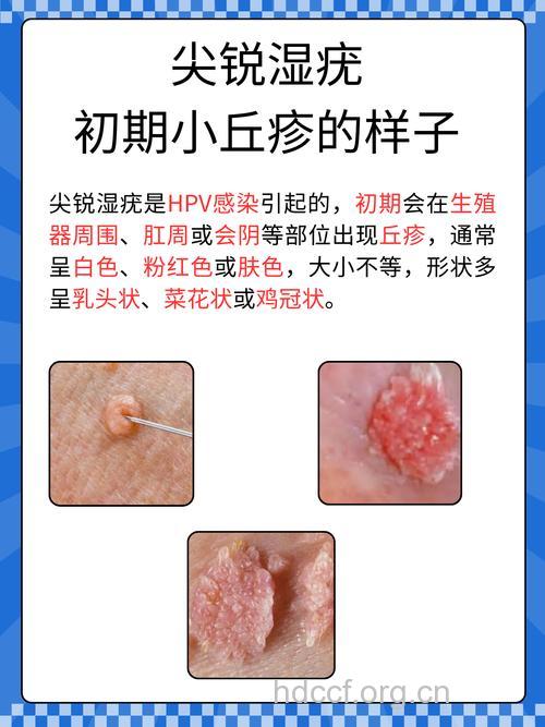 男性尖锐湿疣的早期症状