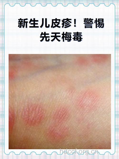 先天性梅毒婴儿会有哪些症状