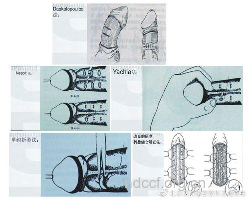 男人手淫会导致阴茎弯曲吗