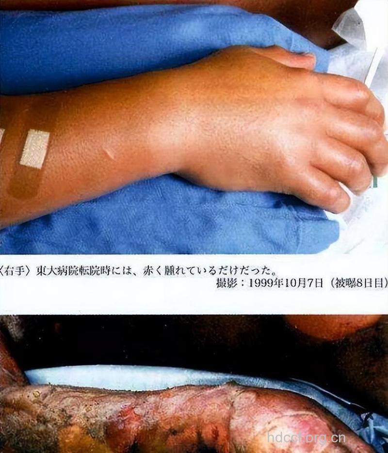 遭受核辐射后有哪些表现症状