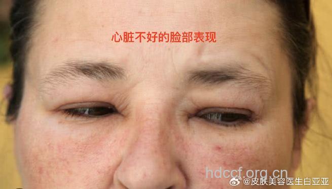 心脏病变通通上“脸”