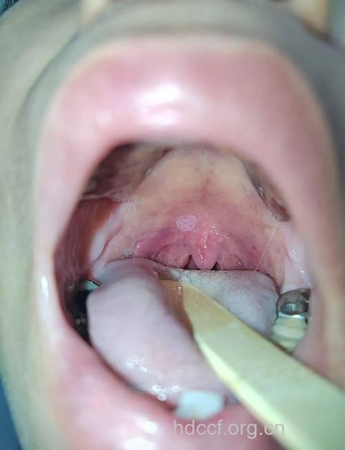 小毛病 露出咽部疾病
