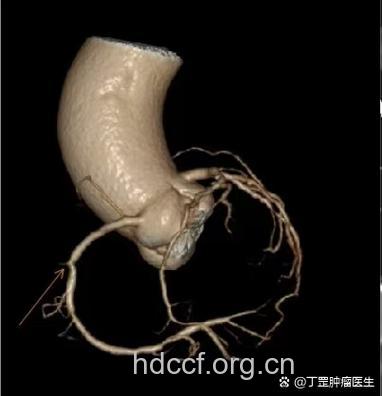 “食战”动脉硬化