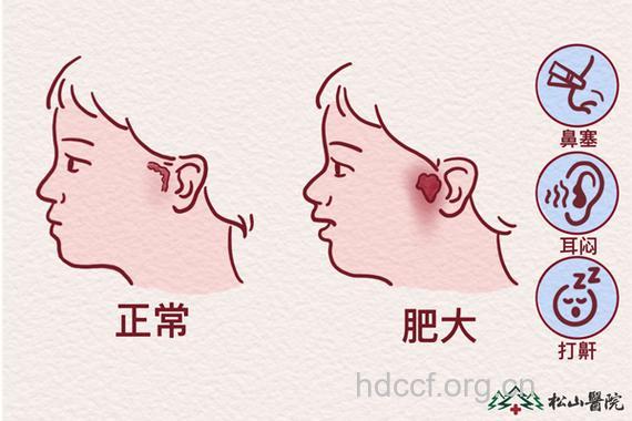 孩子打鼾须警惕腺样体肥大大