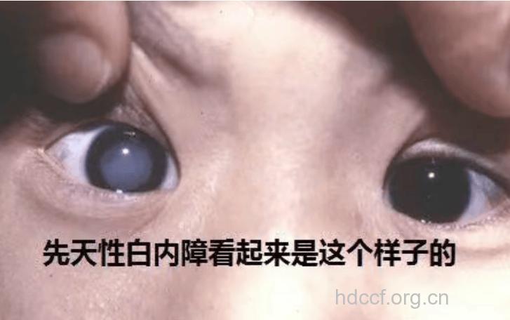 具有遗传性的先天性白内障