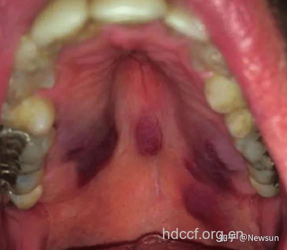 艾滋病口腔症状卡波式肉瘤如何治疗