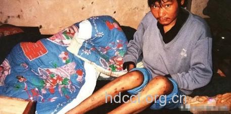 河南艾滋病肆虐之肇始 中国艾滋病患者多吗